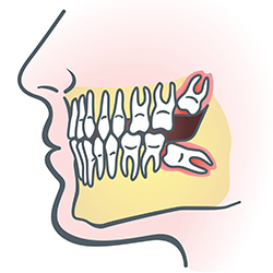 impacted wisdom teeth illustration