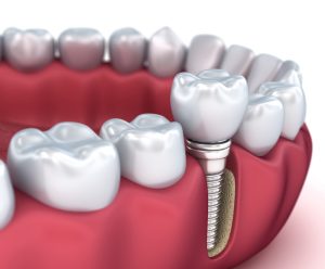 model of implants