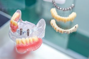 mini dental implant model