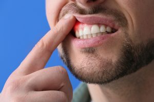 man with red gums